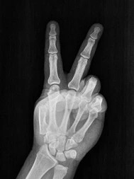 film-xray-radiograph-hand-fingers-260nw-2408410227.jpg