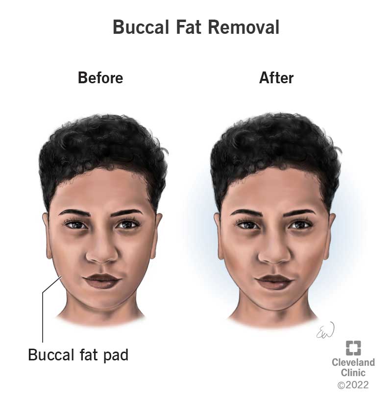 23396-buccal-fat-removal.jpg