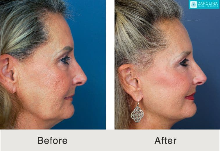 Facelift-buccal-fat-ProfoundRF-for-face-neck-rejuvenation-Kulbersh-Carolina-1.jpeg